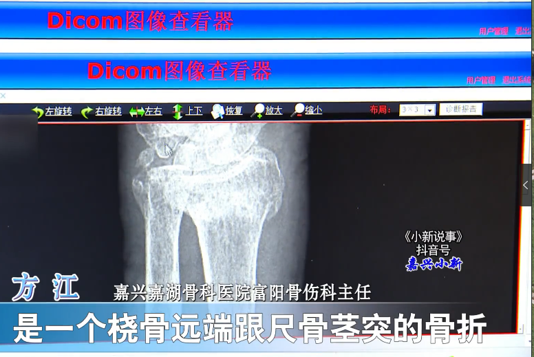 97歲高齡老人，傳統(tǒng)復(fù)位免于手術(shù)3.png